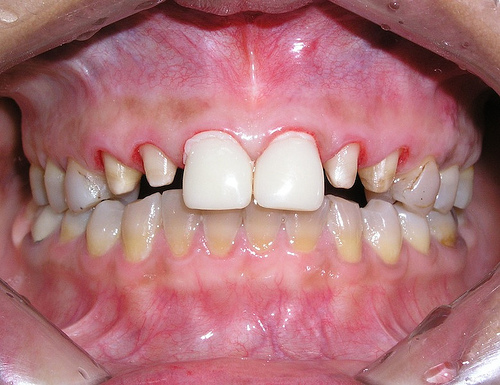 ảnh bệnh nh&acirc;n được lắp răng tạm để bảo vệ c&ugrave;i răng